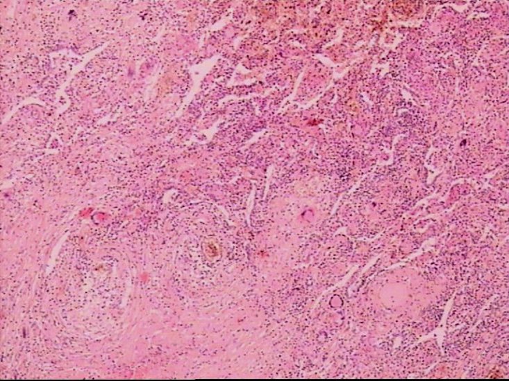 Zdjęcia ze strony katedry patomorfologii - Gruźlica prosowata płuc.JPG